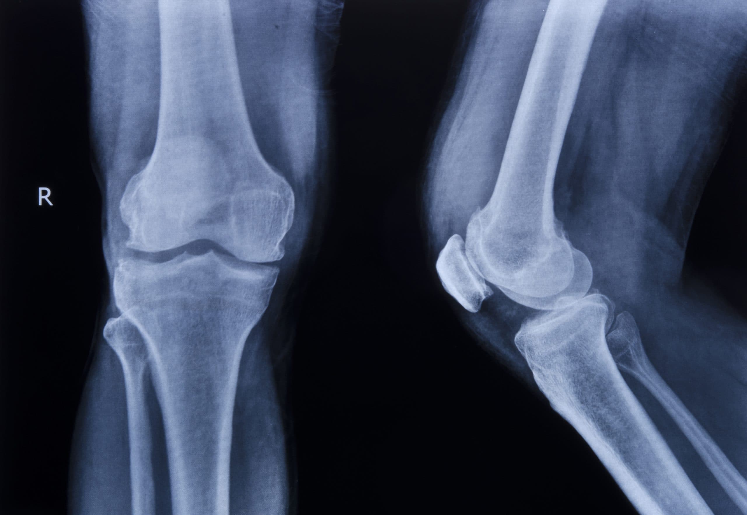 Cartilage surgery