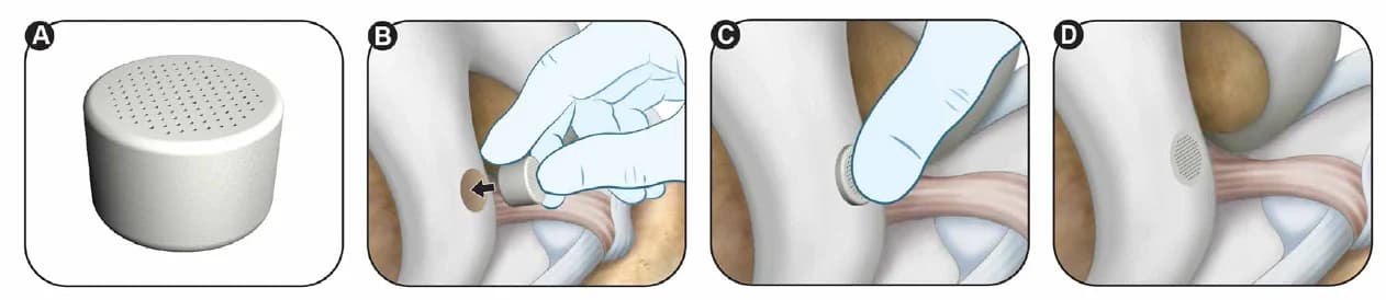 CartiHeal implant being placed into the prepared knee lesion