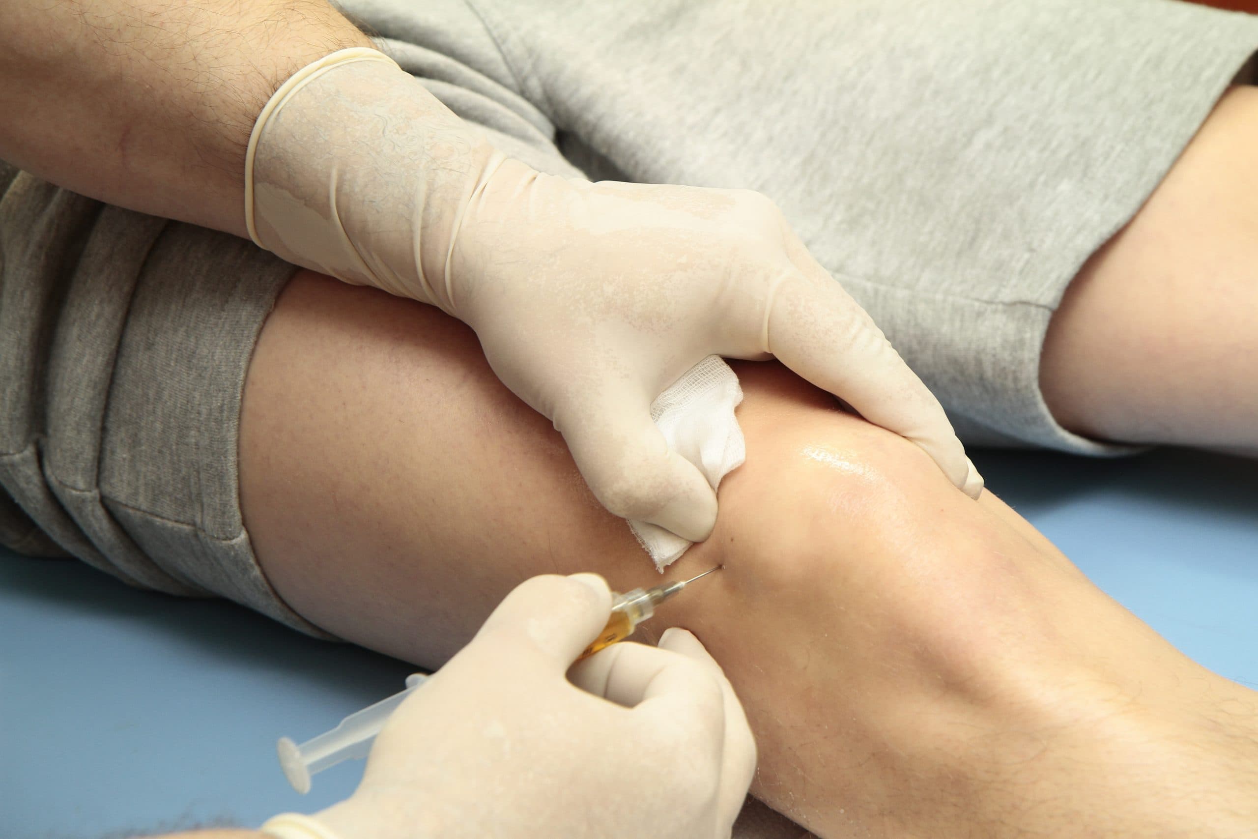 Living micrografts and a collagen scaffold prepared at London Cartilage Clinic