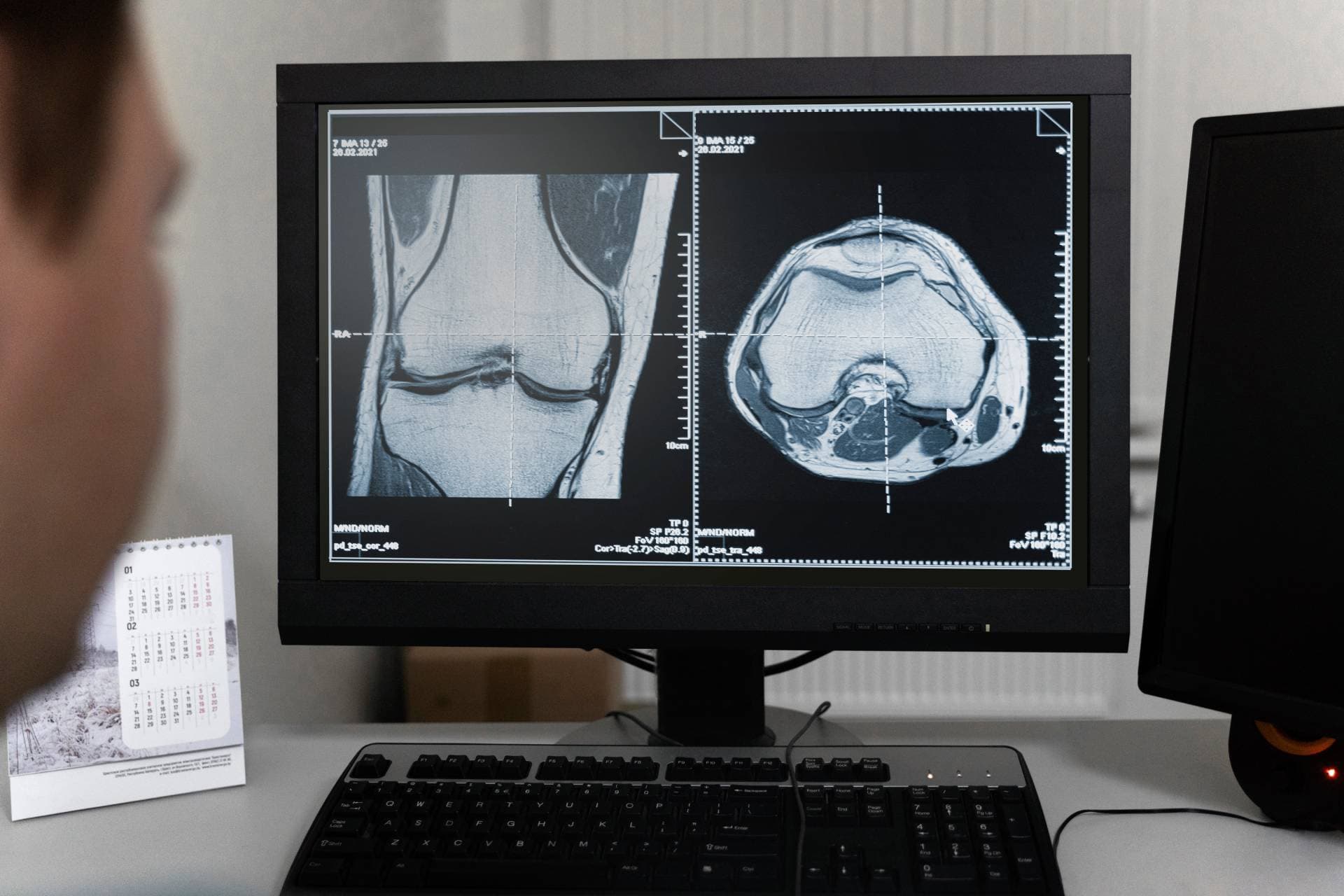 Knee MRI scans being reviewed on a monitor